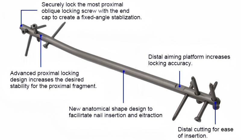 Expert Tibia Nail